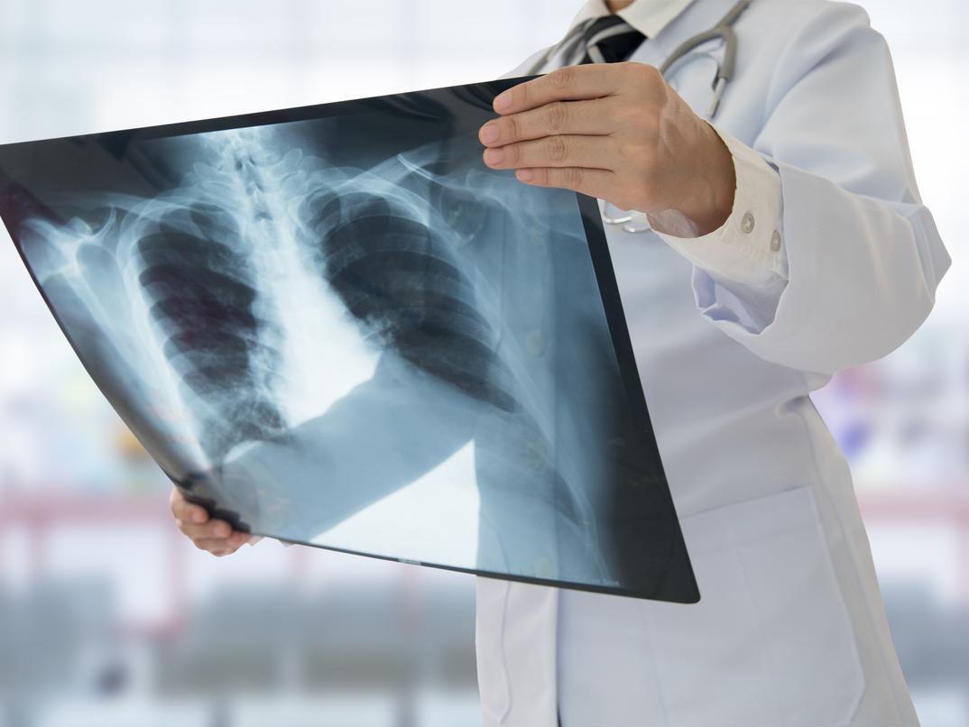 Hausse des cas de tuberculose : Dr. Hamdi met en garde contre la consommation du lait de vache